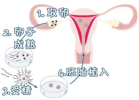 多囊卵巢案例